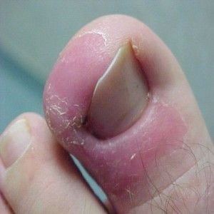 ひょう疽 治療